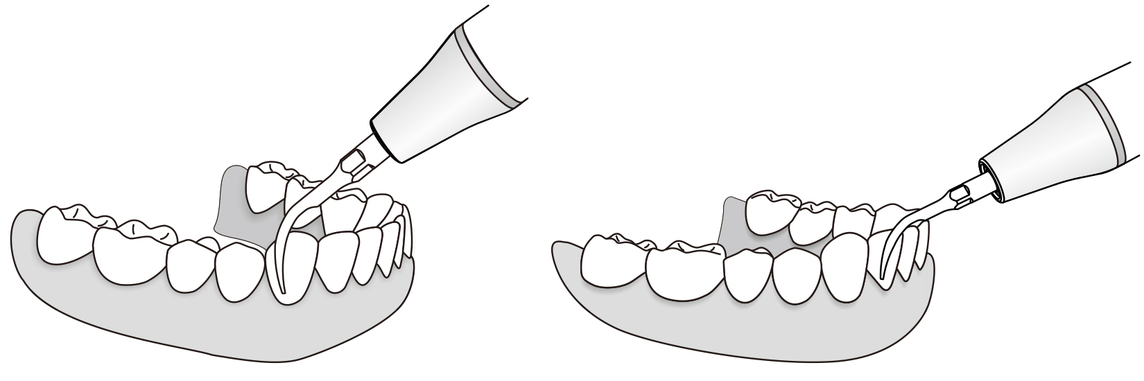 Сфера применения наконечника для скалера